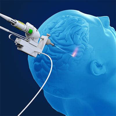 Diagram of laser probe operating on a brain.